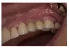 Find minimally invasive Veneers in Tijuana with ultra-thin custom-made shells