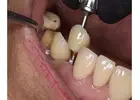 Revive your natural and flawless smiles with holistic Dental care in Tijuana