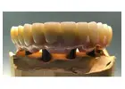 Find minimally invasive Veneers in Tijuana with ultra-thin custom-made shells