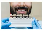 Find minimally invasive Veneers in Tijuana with ultra-thin custom-made shells