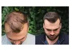 Hair Transplant in Islamabad