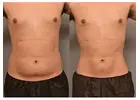 Liposuction Packages and Offers in Islamabad