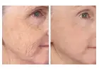 Fractionated CO2 Laser for Acne Scars & Pigmentation in Altamonte Springs, Orlando, Daytona Beac