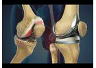 Advanced Knee Replacement Surgeon in Vaishali Nagar | Dr. Arvind Asopa