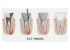 Save Your Tooth – Advanced Root Canal Treatment in Noida