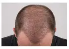 FUT Hair Transplant in Islamabad