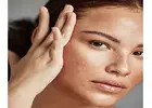 Melasma Treatment in Islamabad