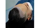 FUE Hair Transplant in Islamabad
