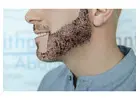 Beard Hair Transplant in Islamabad