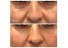 Effective Solutions for Dark Circles & Puffiness Chicago - Opulence Chicago LLC