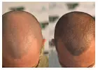 Scalp Micropigmentation in Islamabad