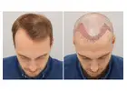 Hair Transplant in Islamabad