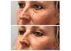 Effective Solutions for Dark Circles & Puffiness Chicago - Opulence Chicago LLC