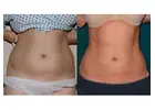 Liposuction in Islamabad