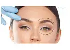 Eyelid Surgery in Islamabad