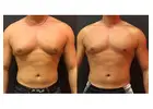 Gynecomastia in Islamabad