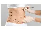 Tummy Tuck in Islamabad: What to Expect