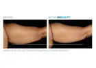 EmSculpt Neo Body Sculpting in West Loop Chicago - Opulence Chicago LLC