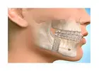 Jaw Surgery in Islamabad for Jaw Pain Relief