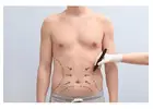 Abdominoplasty in Islamabad