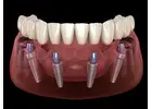 All-on-4 Dental Implants in Tijuana, Mexico – Affordable, Life-Changing Results!