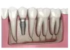 Emergency Dentistry in Abbotsford | Fast, Reliable Emergency Dental Care