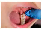Wisdom Teeth Removal in Abbotsford | Safe & Comfortable Care