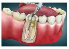 Root Canal Treatment Guide in Abbotsford | What You Need to Know