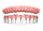 All-on-4 Dental Implants in Tijuana, Mexico – Affordable, Life-Changing Results!