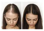 Hair Loss Solutions Dallas | Women’s Thinning Hair Specialist