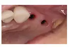 All-on-4 Dental Implants in Tijuana, Mexico – Affordable, Life-Changing Results!