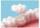 Dental Crown Cost and Types in Abbotsford: A Complete Guide